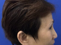 after brow lift right side view female patient case 8911
