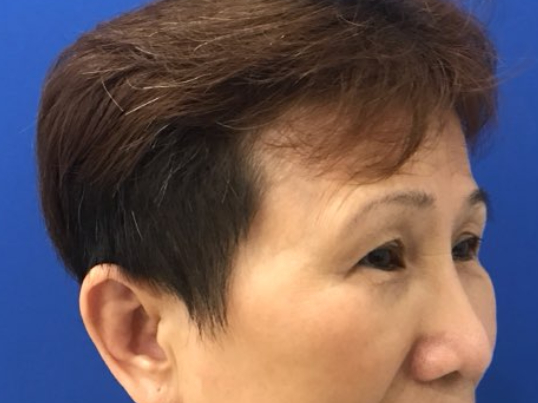before brow lift right angle view female patient case 8911