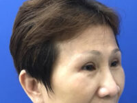 after brow lift right angle view female patient case 8911