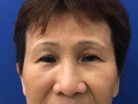 before brow lift front view female patient case 8911