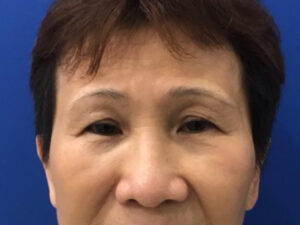 before brow lift front view female patient case 8911
