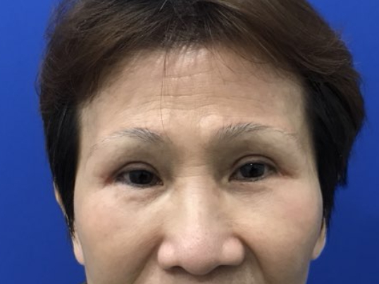 after brow lift front view female patient case 8911
