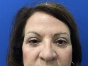 after brow lift front view female patient case 8921