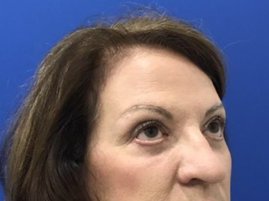 after brow lift right angle view female patient case 8921