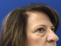 before brow lift right angle view female patient case 8921