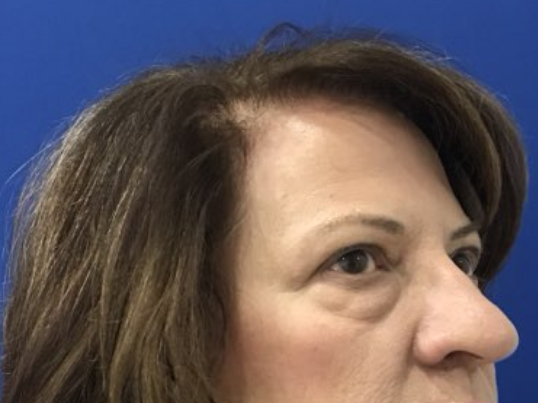 before brow lift right angle view female patient case 8921