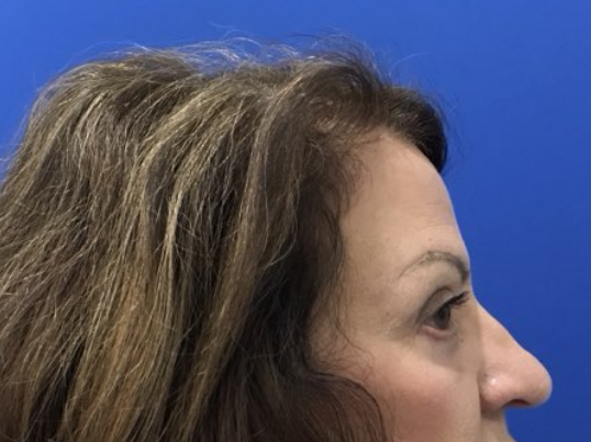 after brow lift right side view female patient case 8921