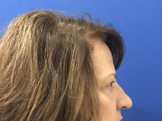 before brow lift right side view female patient case 8921