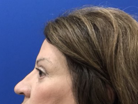 after brow lift left side view female patient case 8921