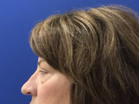before brow lift left side view female patient case 8921